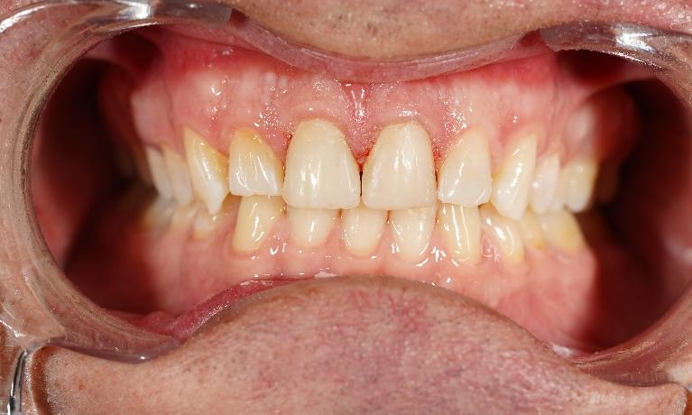 Before-and-After-After-Image